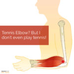 Pickle Ball or Tennis Elbow - But I Dont Even Play Tennis
