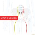Lake Hallie, WI - What is Sciatica